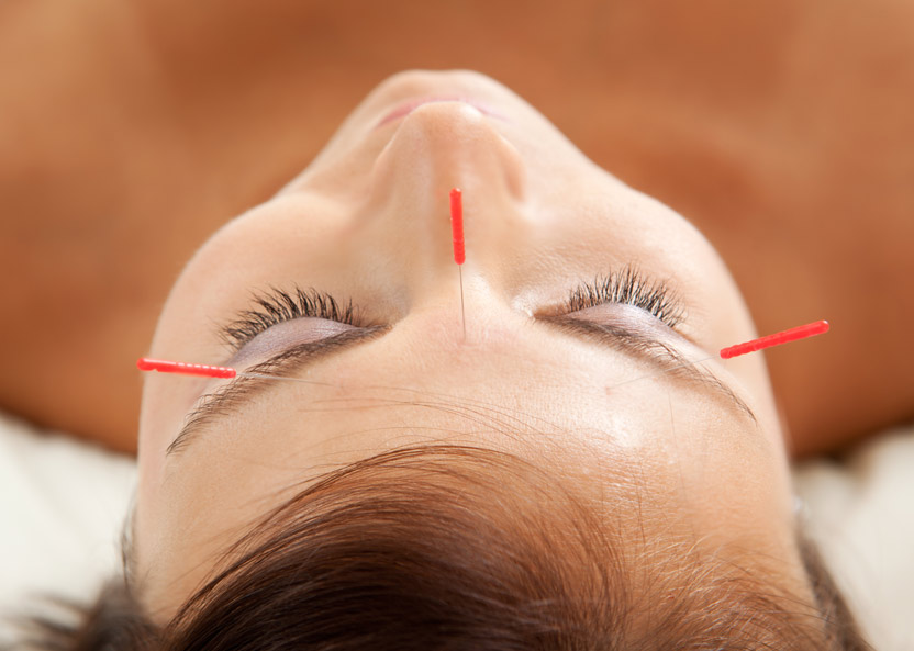 Treating pain with acupuncture