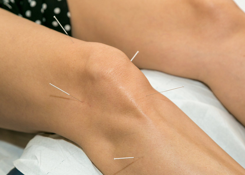 Acupuncture for musculo skeletal pain